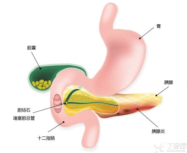 胆结石需要做哪些检查