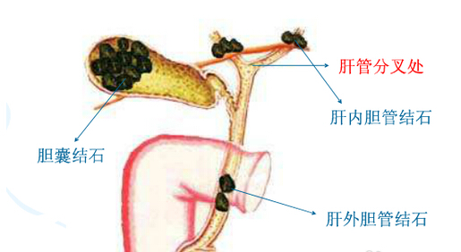 这样做可高效治疗胆结石