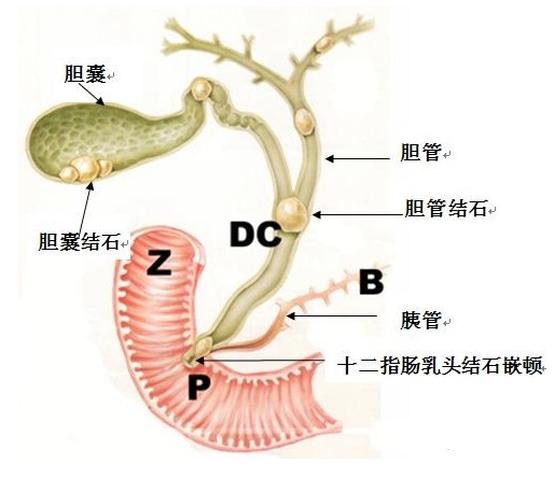 多大的胆结石需要做手术