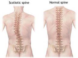 脊柱侧弯的症状和治疗
