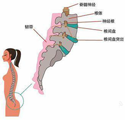 脊椎骨质增生