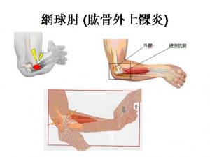 网球肘全面解析