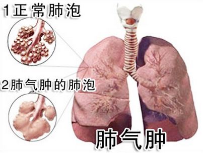 肺气肿的临床症状是什么？