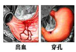 胃穿孔有哪些症状