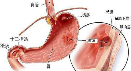拉萨治疗胃穿孔的医院