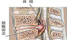 颈椎间盘有哪些危害