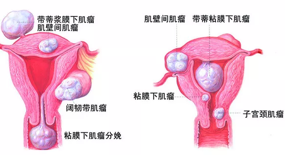 子宫肌**严重吗?