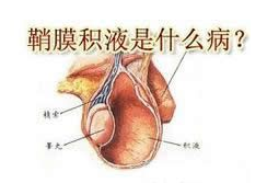 鞘膜积液怎么回事