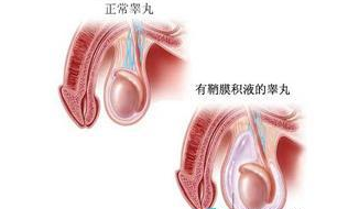 拉萨治疗鞘膜积液医院