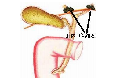 胆管结石危害大吗