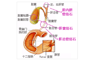 胆管结石的症状