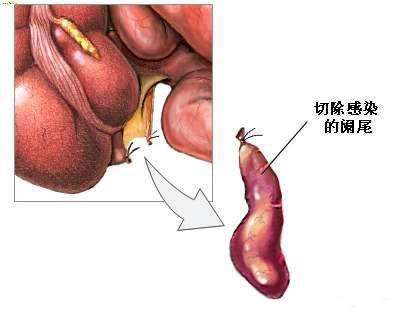 慢性阑尾炎怎么引起的