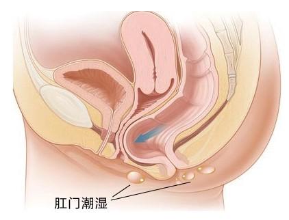 肛门“出汗了”，怎么治