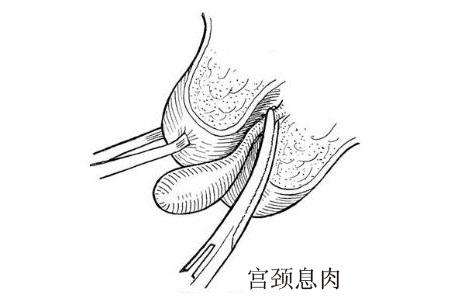 结婚前遭遇宫颈息肉怎么办?