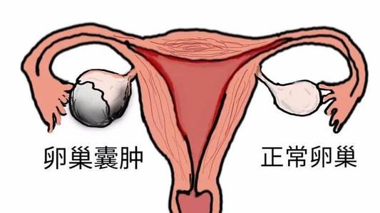 卵巢囊肿会引发哪些问题?