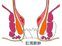 大叔满头大汗，来到恒大肛肠科求助